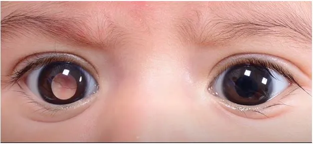retinoblatopia-pic
